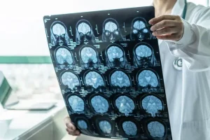 dokter spesialis saraf Probolinggo